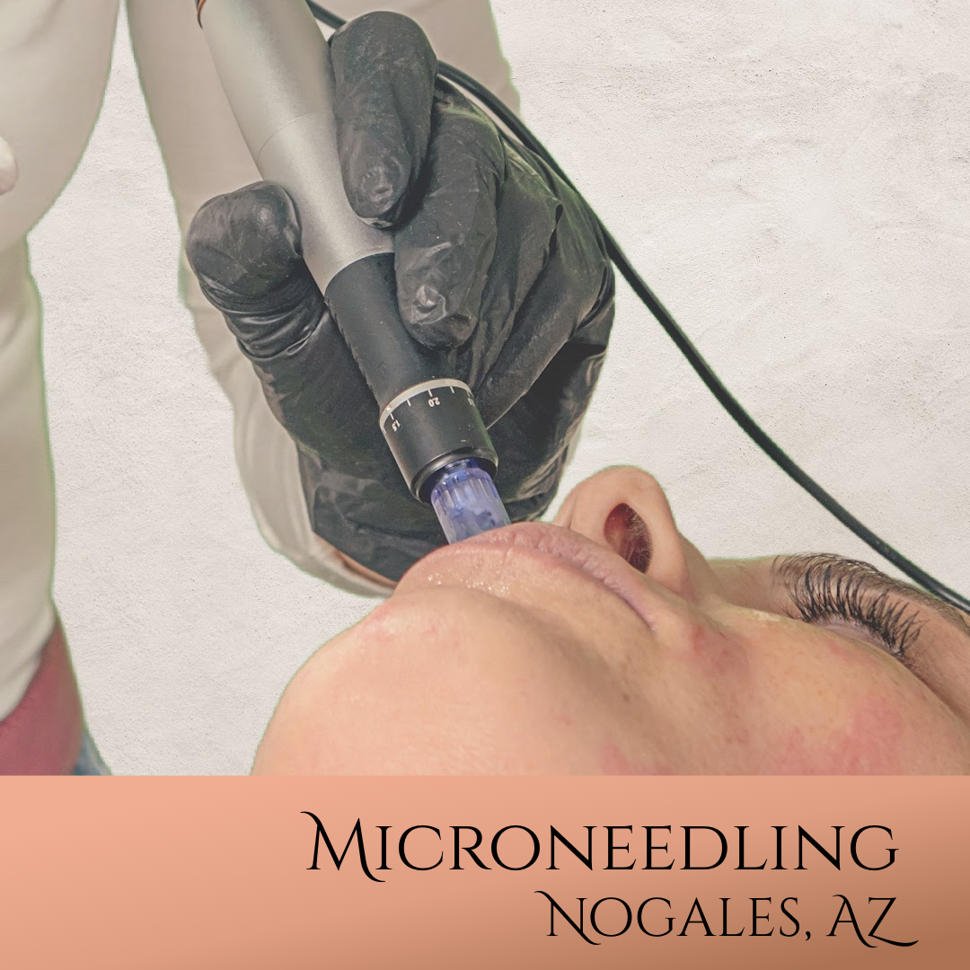 Microneedling Facial at Nogales, AZ